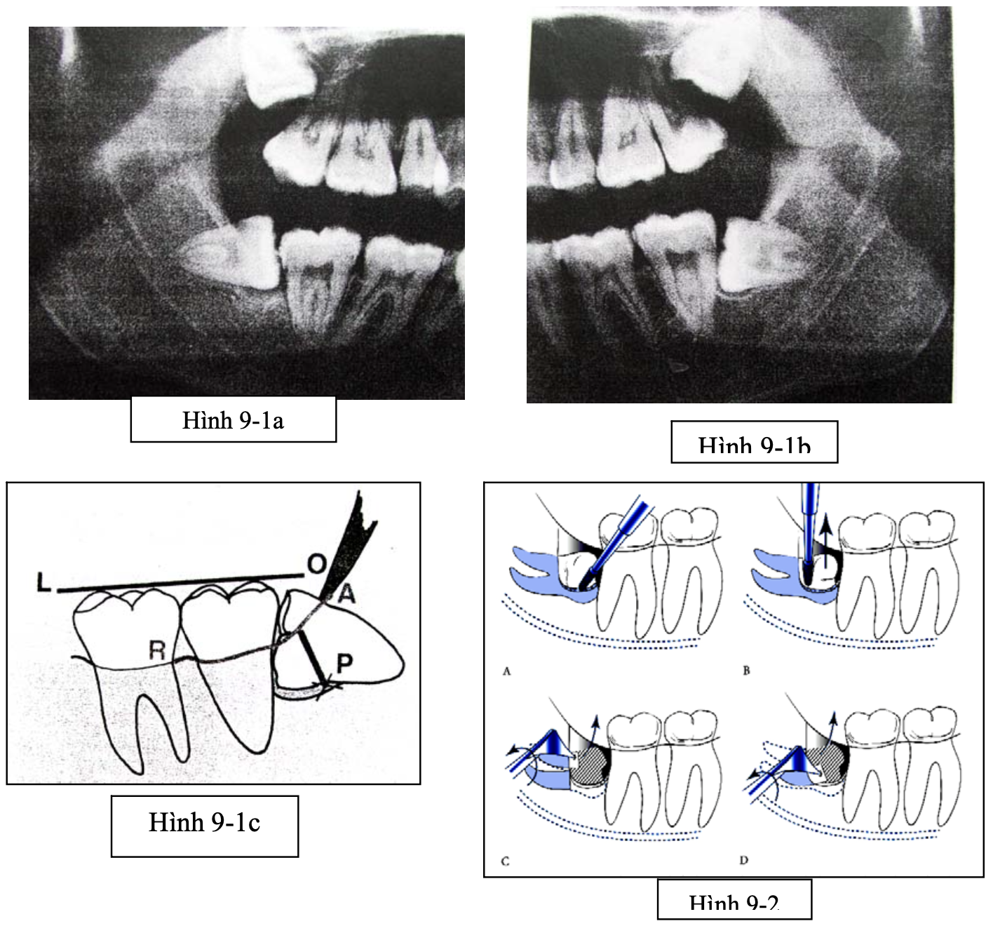Tiểu phẫu răng khôn nghiêng gần 90 độ